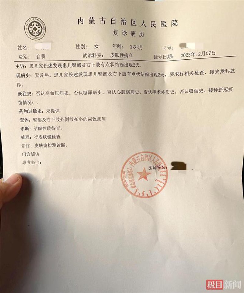 牛皮癣：从困扰到治愈的故事